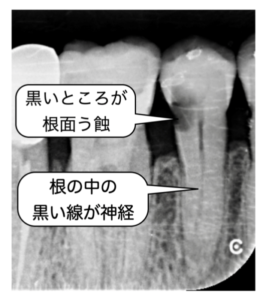 う蝕　むし歯　虫歯　治療